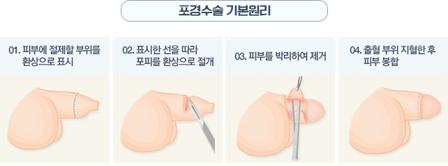 강남멘파워비뇨기과-포경수술  기본원리